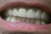 Dr. Tartaglione DDS patient results images