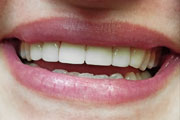 Dr. Tartaglione DDS patient results for porcelain laminate veneers.